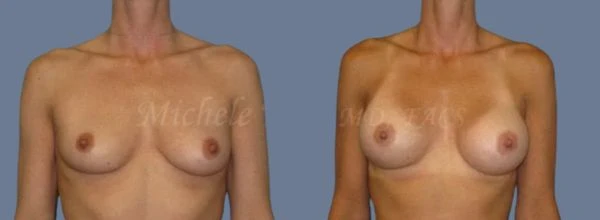 Front-facing before and after of breast lift with augmentation for subtle volume by Dr. Michele Koo in Menlo Park & St Louis.